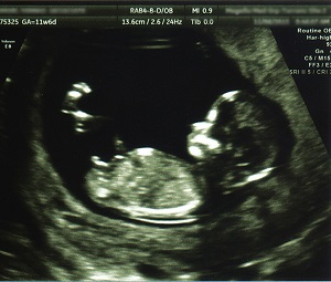 エコー写真で見る子宮の中にいる赤ちゃん